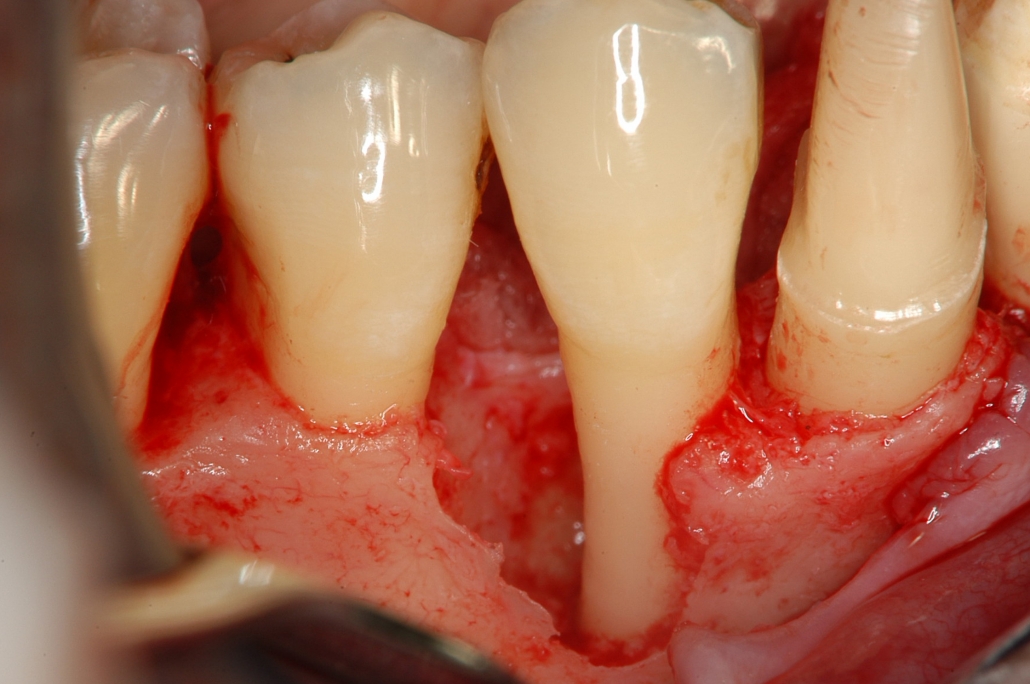 歯 周 病 溶け た 骨 再生