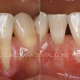 歯肉退縮に対する根面被覆術